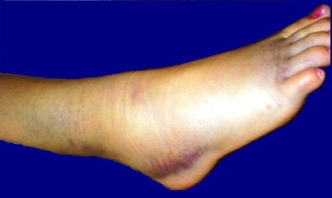 sprained-ankle