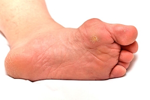 Are Bunions a Deformity?