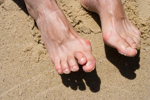 The Hindering Effects of Hammertoe