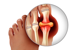Dangers of Tophi From Chronic Gout