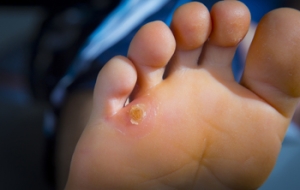 What Happens When Corns Rub You the Wrong Way